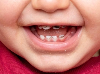 أفضل علاج تسوس أسنان الأطفال بعمر سنة ونصف في مجمع الطب المتميز