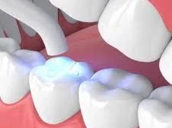 حشو البلاتين الأبيض: الفرق بينه وبين الأنواع الأخرى ومتى يُستخدم؟