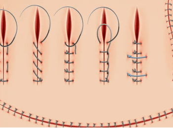 الخياطة التجميلية للمنطقة الحساسة أنواعها وخطوات إتمامها وتكلفتها المادية