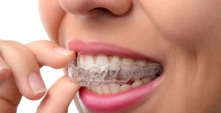 مثبت التقويم الداخلي للأسنان: أنواعه وأهميته بعد إزالة التقويم
