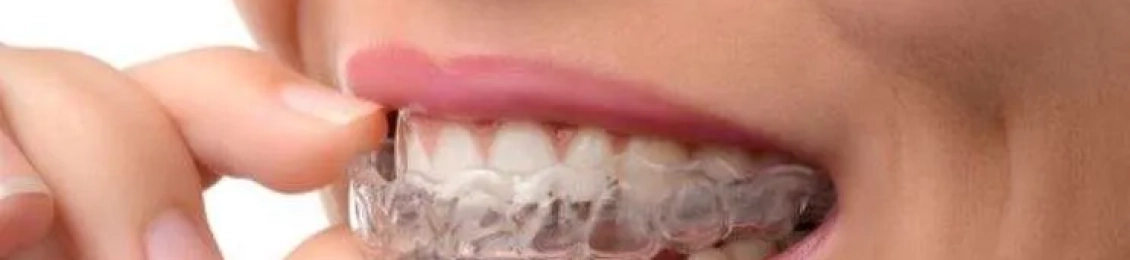 مثبت التقويم الداخلي للأسنان: أنواعه وأهميته بعد إزالة التقويم