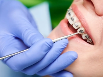 هل التقويم يضعف الأسنان؟ الحقائق العلمية وراء المعلومة الشائعة