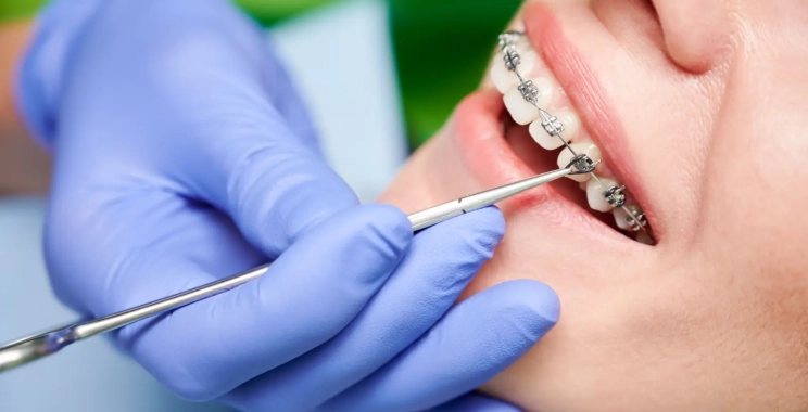 هل التقويم يضعف الأسنان؟ الحقائق العلمية وراء المعلومة الشائعة