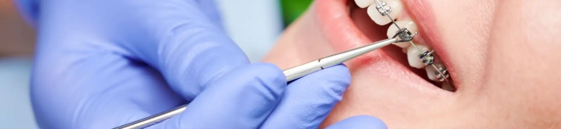 هل التقويم يضعف الأسنان؟ الحقائق العلمية وراء المعلومة الشائعة