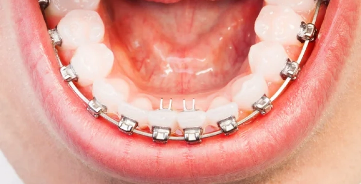 هل التقويم يعدل الفك السفلي مع أفضل اطباء الأسنان