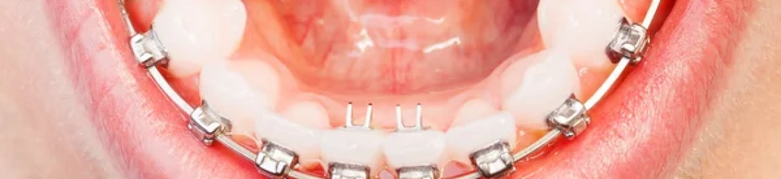 هل التقويم يعدل الفك السفلي مع أفضل اطباء الأسنان