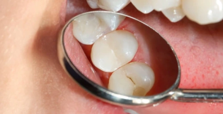 كيفية علاج التهاب اللثة بعد حشو الضرس؟ أهم النصائح