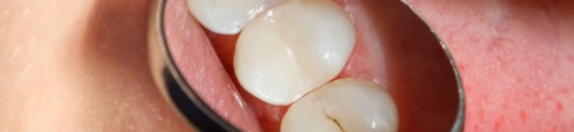 كيفية علاج التهاب اللثة بعد حشو الضرس؟ أهم النصائح