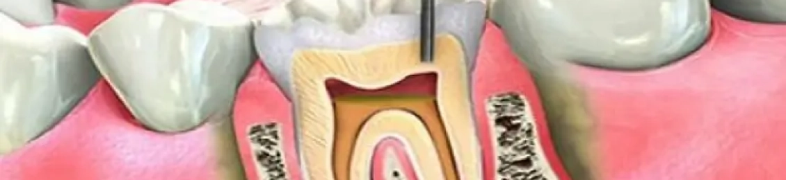 علاج التهاب عصب السن بسرعة وأمان في مجمع الطب المتميز