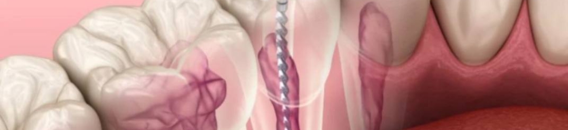 أفضل طرق فعالة في علاج التهاب عصب السن؟