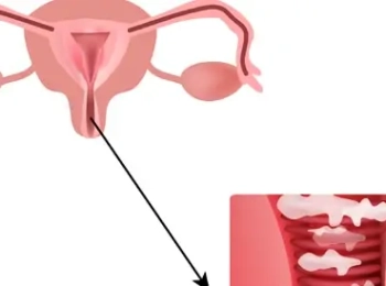 افضل طرق علاج التهابات المهبل عند العذراء