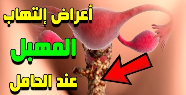 علاج حكة المهبل للحامل ونوع الجنين: طرق آمنة ومجربة