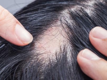 هل الثعلبة معدية ؟ وكيف يمكن العلاج؟