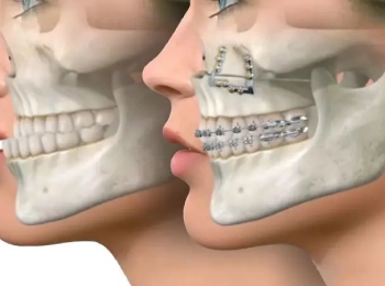 التقويم الجراحي للفكين مع اطباء مجمع الطب المتميز