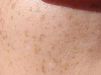 فطريات الجلد بالصور الأسباب والأعراض وطرق العلاج مع د.زينب جلال