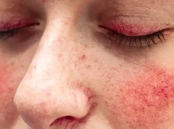 فطريات الجلد الحمراء واسبابها مع د.زينب جلال