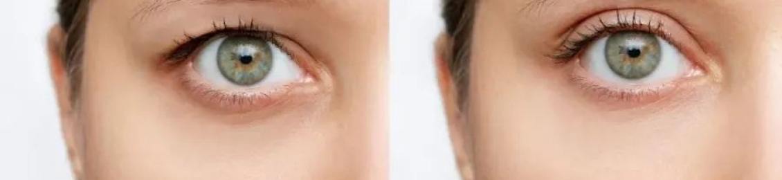 ارتفاع الحاجب بعد البوتكس: الأسباب والحلول