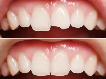 افضل حشوة تجميلية للاسنان الامامية في المدينة المنورة