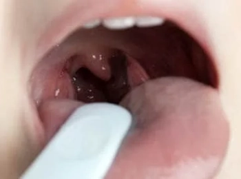 التهاب الحلق لا يستجيب للمضاد؟ الأسباب والعلاج المناسب