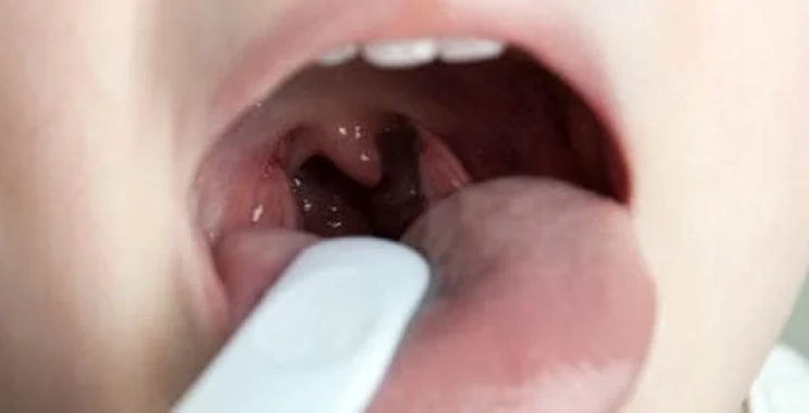 التهاب الحلق لا يستجيب للمضاد؟ الأسباب والعلاج المناسب