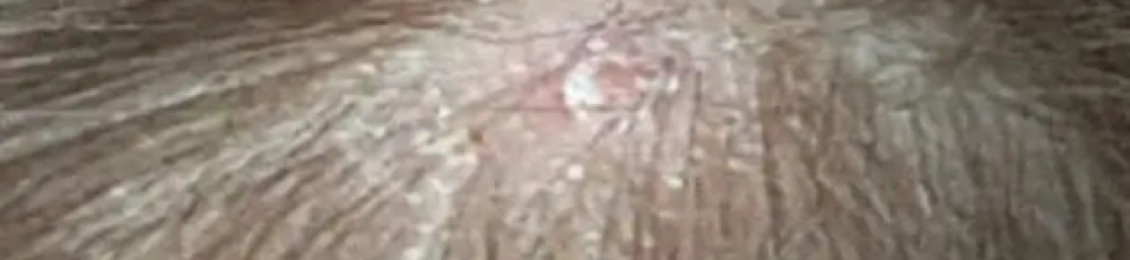 أسباب فطريات الشعر ونصائح لتجنبها 