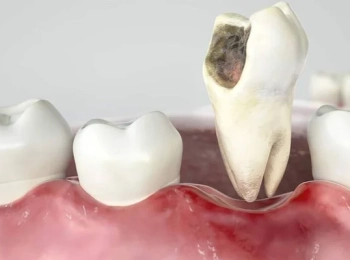 علاج الضرس المحفور الملتهب: خطوات العلاج والأدوية الموصى بها