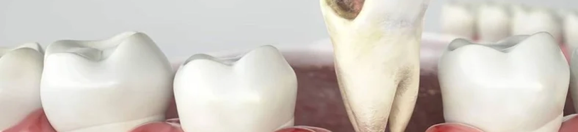 علاج الضرس المحفور الملتهب: خطوات العلاج والأدوية الموصى بها