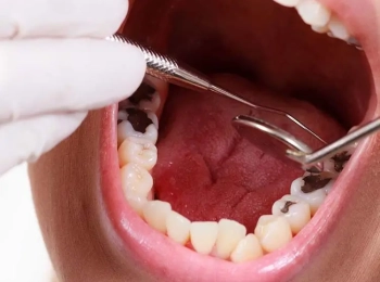 علاج الضرس المحفور الملتهب للأطفال في مجمع الطب المتميز بالمدينة المنورة