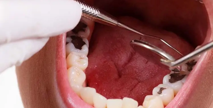علاج الضرس المحفور الملتهب للأطفال في مجمع الطب المتميز بالمدينة المنورة