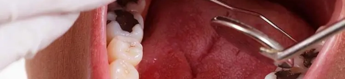 علاج الضرس المحفور الملتهب للأطفال في مجمع الطب المتميز بالمدينة المنورة