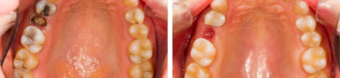 طرق فعالة في علاج الضرس المحفور الملتهب والمنتفخ في العيادة