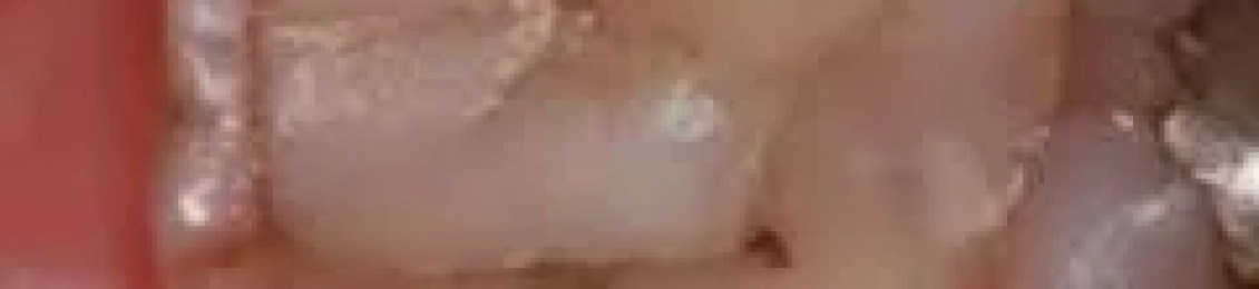 كيف تعالج وجع الضرس بعد حشو العصب بشهرين