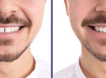 أفضل تكلفة علاج الفراغات بين الأسنان بأحدث التقنيات