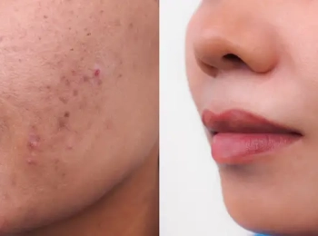 هل الفراكشنال ليزر يعالج حب الشباب؟ النتائج المتوقعة وعدد الجلسات