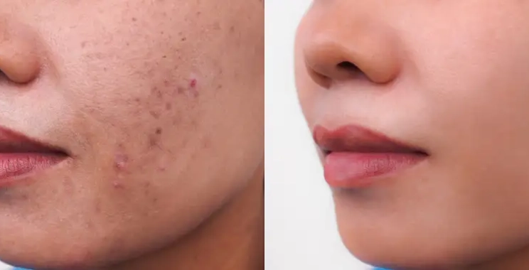 هل الفراكشنال ليزر يعالج حب الشباب؟ النتائج المتوقعة وعدد الجلسات