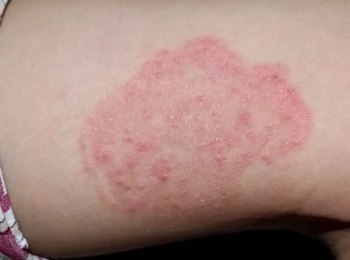 ما هي أنواع الفطريات الجلدية وطرق الوقاية منها