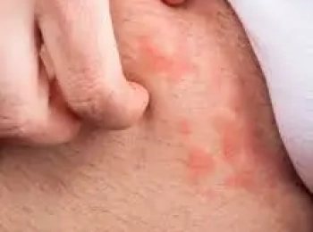 تعرف على شكل الفطريات في الجسم وعلاجها مع د.زينب جلال