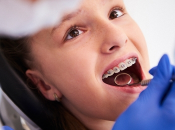 تعرف على تقويم الفك العلوي للاطفال وفوائده