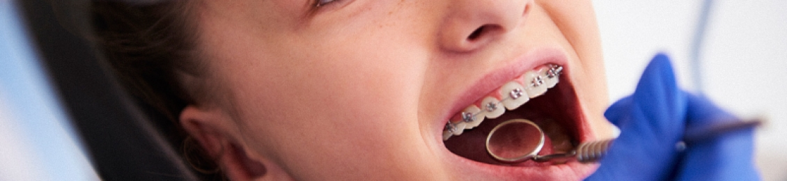 تعرف على تقويم الفك العلوي للاطفال وفوائده