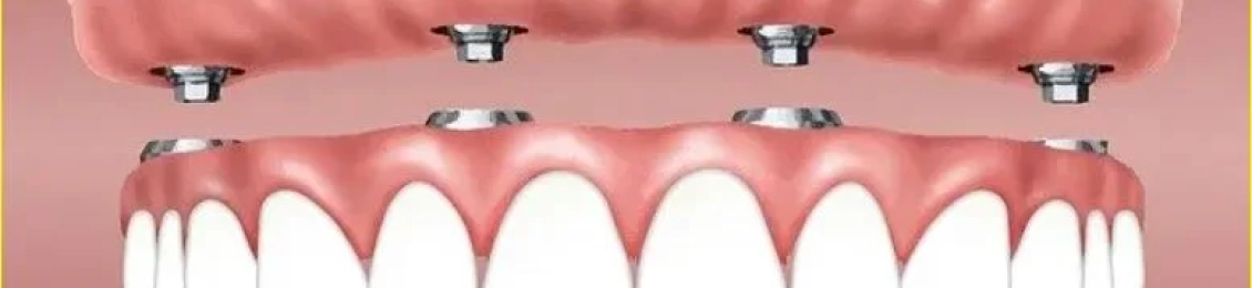 افضل تقنيات زراعة الفك الكامل مع د.محمد بشار