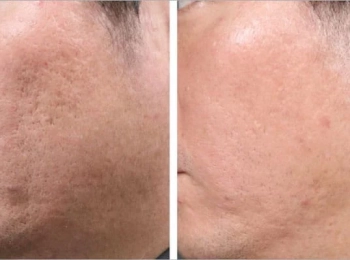 هل الليزر يقضي على حب الشباب نهائيًا أم يقلل ظهوره فقط؟