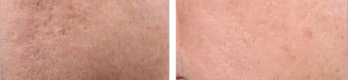 هل الليزر يقضي على حب الشباب نهائيًا أم يقلل ظهوره فقط؟