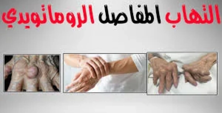 التهاب المفاصل الروماتويدي: الأسباب والأعراض والعلاج