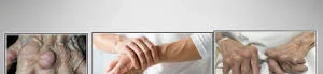 التهاب المفاصل الروماتويدي: الأسباب والأعراض والعلاج