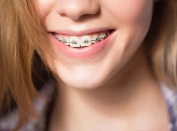 ما هو العمر المناسب لتقويم الاسنان؟