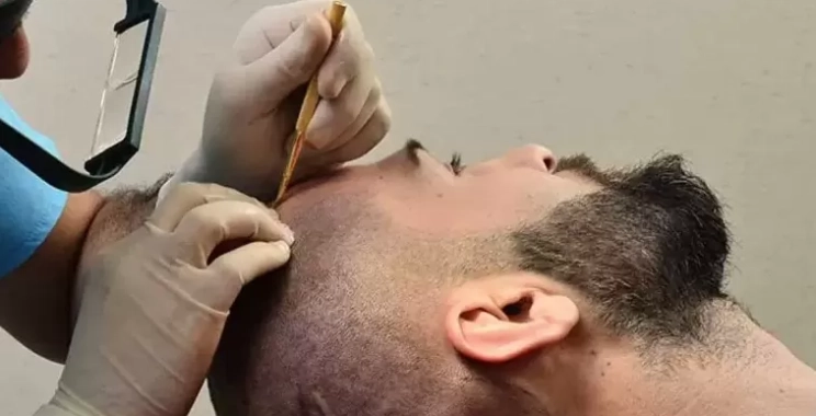 العمر المناسب لزراعة الشعر: متى تكون النتائج الأفضل؟
