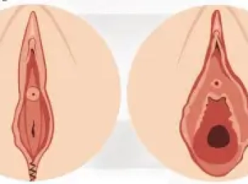 شكل المهبل بعد الخياطه التجميليه