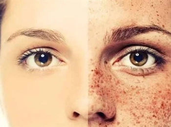 كيف يمكن علاج النمش نهائيا مع مجمع الطب المتميز؟