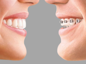 نصائح تقويم اسنان قبل وبعد مع افضل الاطباء