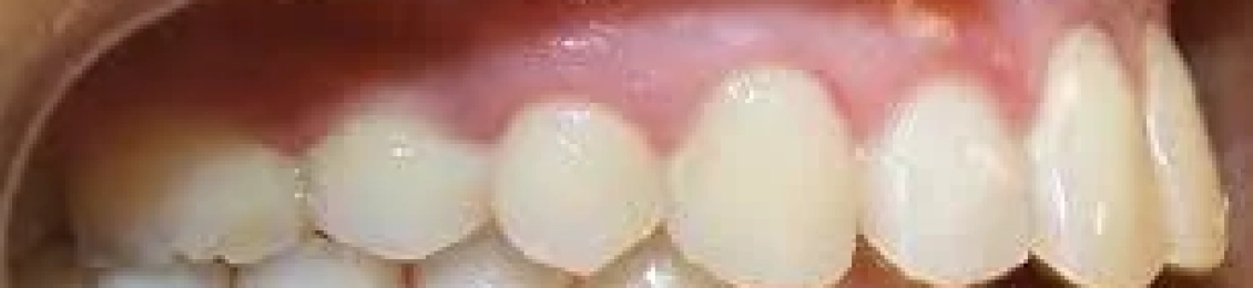 علاج بروز الفك العلوي للاطفال: متى يبدأ وما هو أفضل وقت للعلاج؟